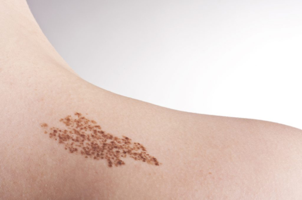 Что за пигментные пятна появляются на спине?