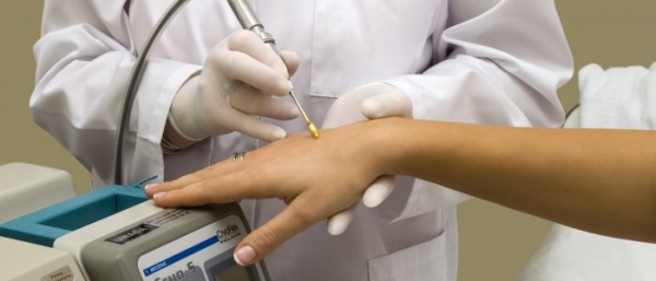 Удаление бородавок азотом