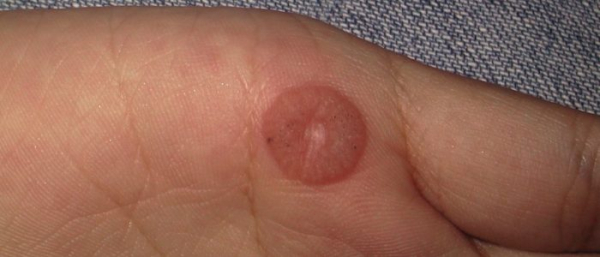 Бородавка или сухая мозоль