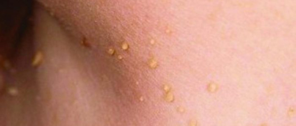 Бородавка на шее