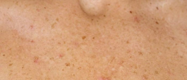 Пигментное пятно на лице от солнца