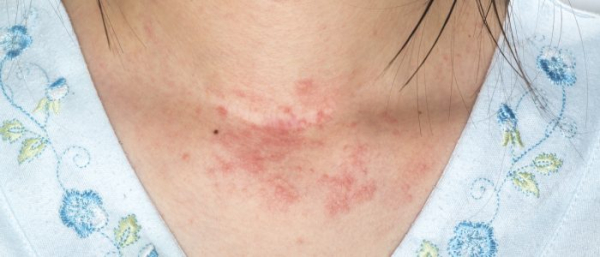 Пигментная пурпура Шамберга