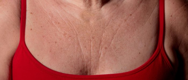 Пигментные пятна на молочной железе