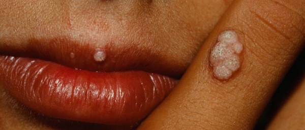 Белые бородавки