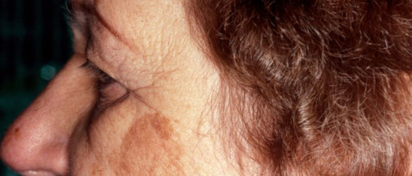 Пигментные пятна и рак кожи