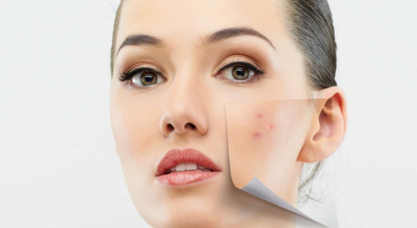 Прыщи и пигментация