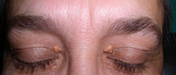 Пигментные пятна на веках глаз