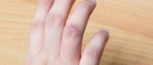 Повреждение бородавки