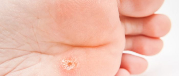 Шипица на ступне и на пальце ноги