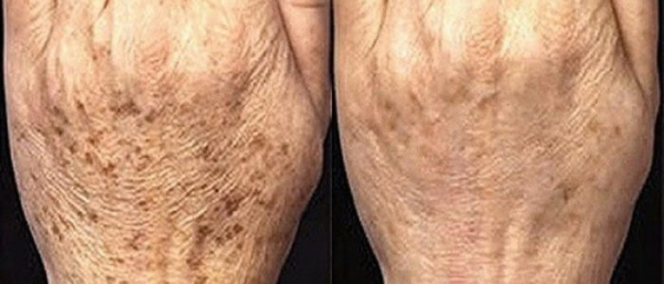 Пигментные пятна на руке