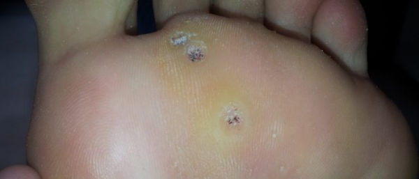 Подошвенные бородавки