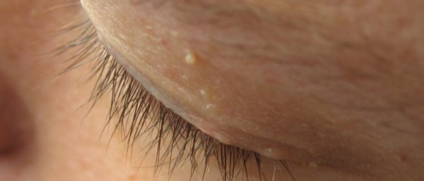 Удаление бородавок на веке