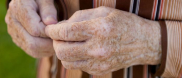 Пигментные пятна на теле мужчин