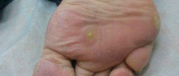 Корни бородавки