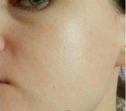 911 &ndash; крем от прыщей