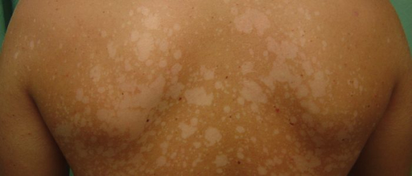 Белое пятно на коже