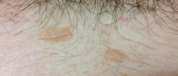 Коричневые пятна в области паха