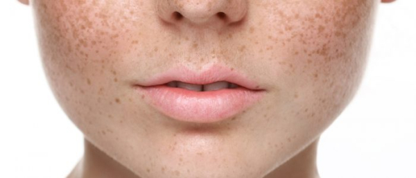 Как убрать пигментные пятна на губах?