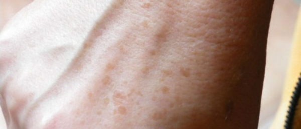 Пигментные заболевания кожи