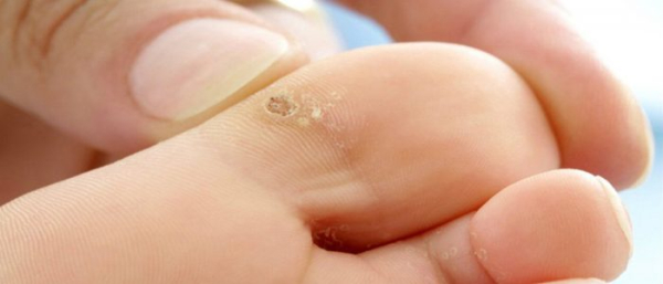 Как быстро вывести бородавку в домашних условиях?