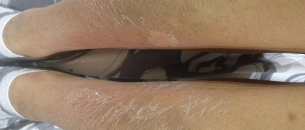 Пигментные пятна на ноге