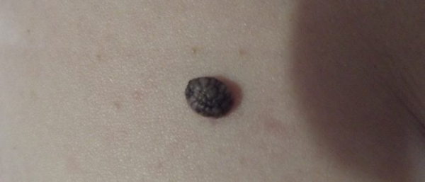 Черная бородавка