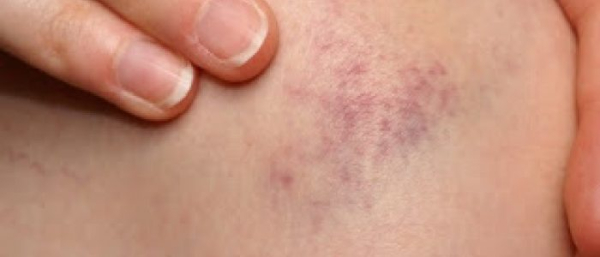 Пигментные пятна от синяка