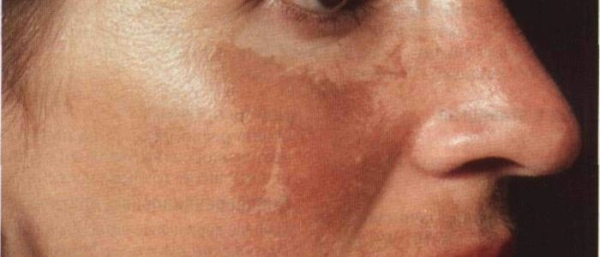 Ансил при пигментных пятнах