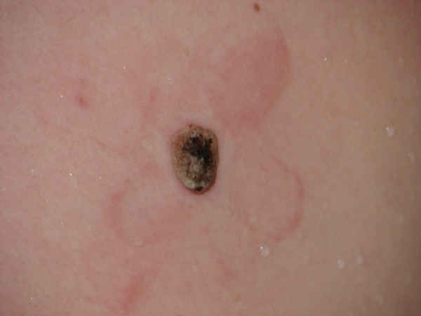 Черная бородавка