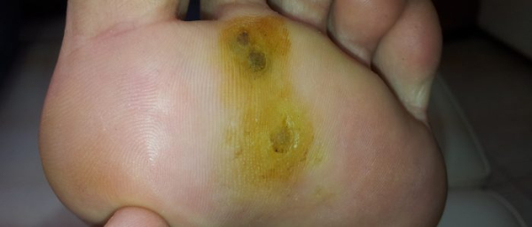 Как избавиться от подошвенных бородавок?