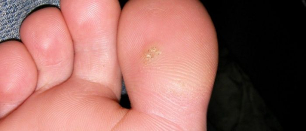 Как вывести шипицу?