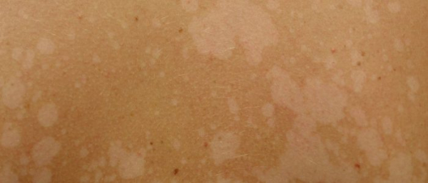 Что за пигментные пятна появляются на спине?