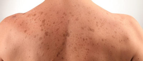 Пигментные пятна по всему телу