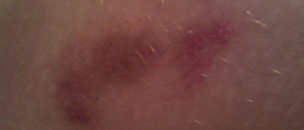 Черные пятна на животе