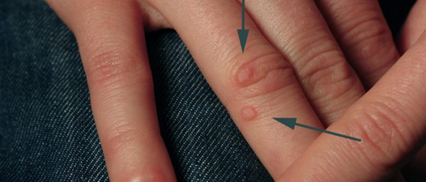 Могут ли бородавки исчезнуть сами?