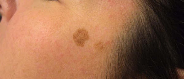 Пигментация на лице