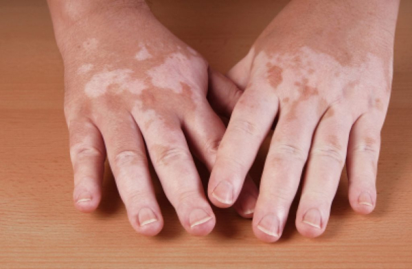 Пигментные заболевания кожи