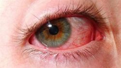 Фурацилин при прыщах