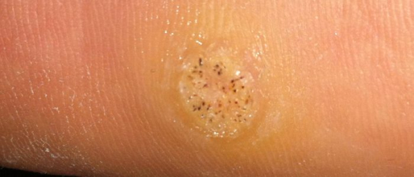 Как выглядят наросты?