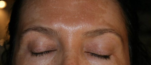 Что такое хлоазма?