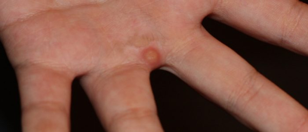 Шипица на руке и пальцах