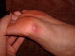 Как лечить шипицы в домашних условиях?