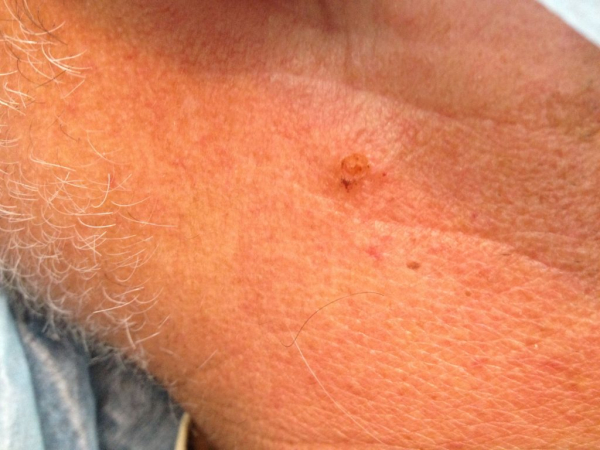 Плоская бородавка