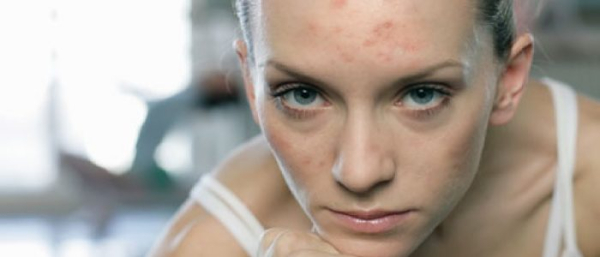 Бородавка на лице