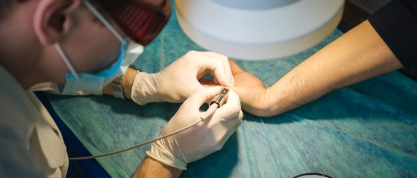 Выжигание бородавок лазером