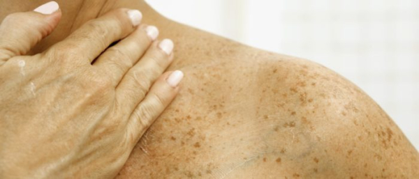 Как избавиться от пигментных пятен после загара?