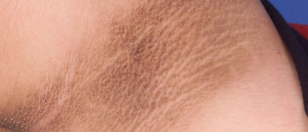 Пигментное пятно шелушится