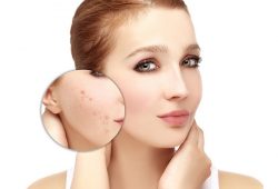 Амидель &ndash; гель от прыщей