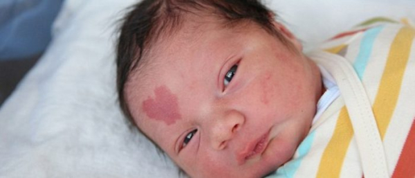 Как появляются родимые пятна у детей?