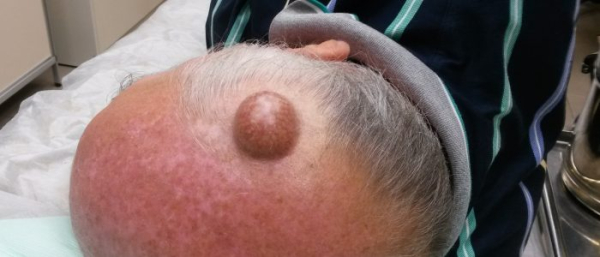 Атерома кожи